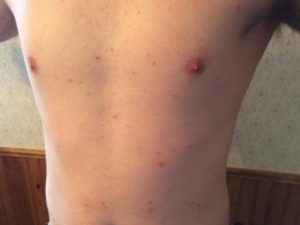 Bed bug bites | Bed Bug Exterminator Indiana