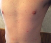 Bed Bug Bites or Rash on the Chest